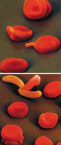 The shape and functions of red corpuscles are compromised in sickle-cell anemia. For this reason, their oxygen-carrying capacities are weakened.
