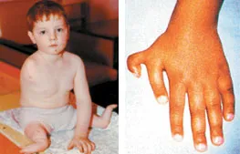 A disastrous effect of mutations on the human body. (right)The boy at left is a Chernobyl nuclear plant accident victim.