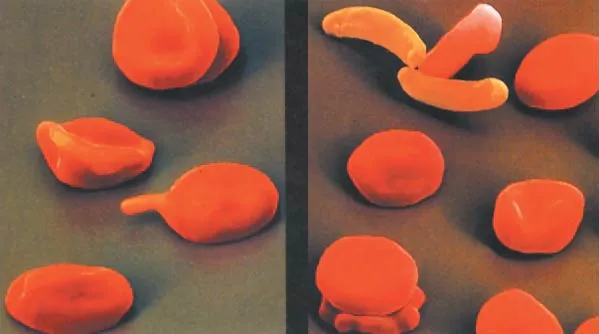 The shape and function of red blood cells are distorted in sickle cell anemia. Their ability to transport oxygen is thus impaired.